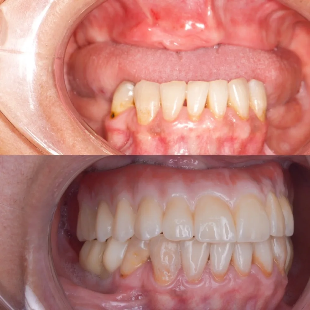 Rehabilitación completa sobre implantes — Antes/después lateral