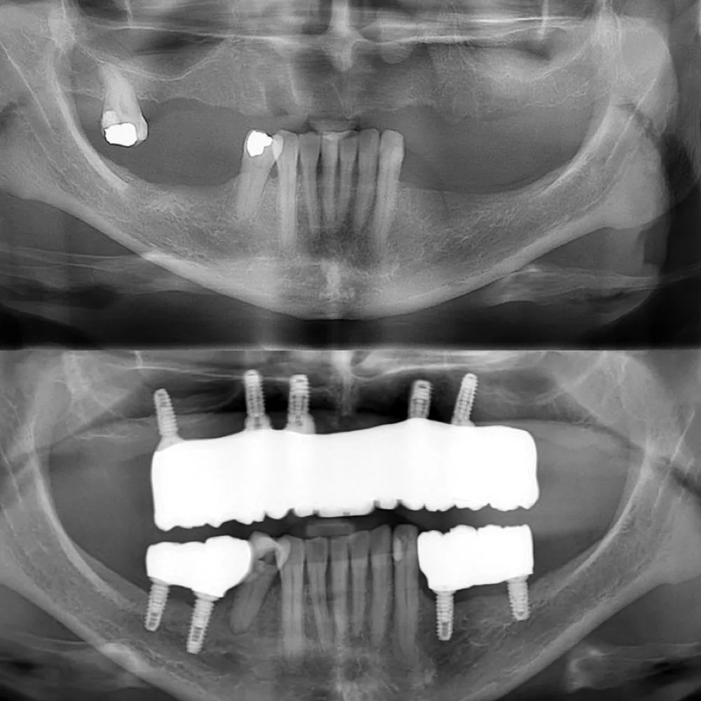 Rehabilitación completa sobre implantes — Radiografía