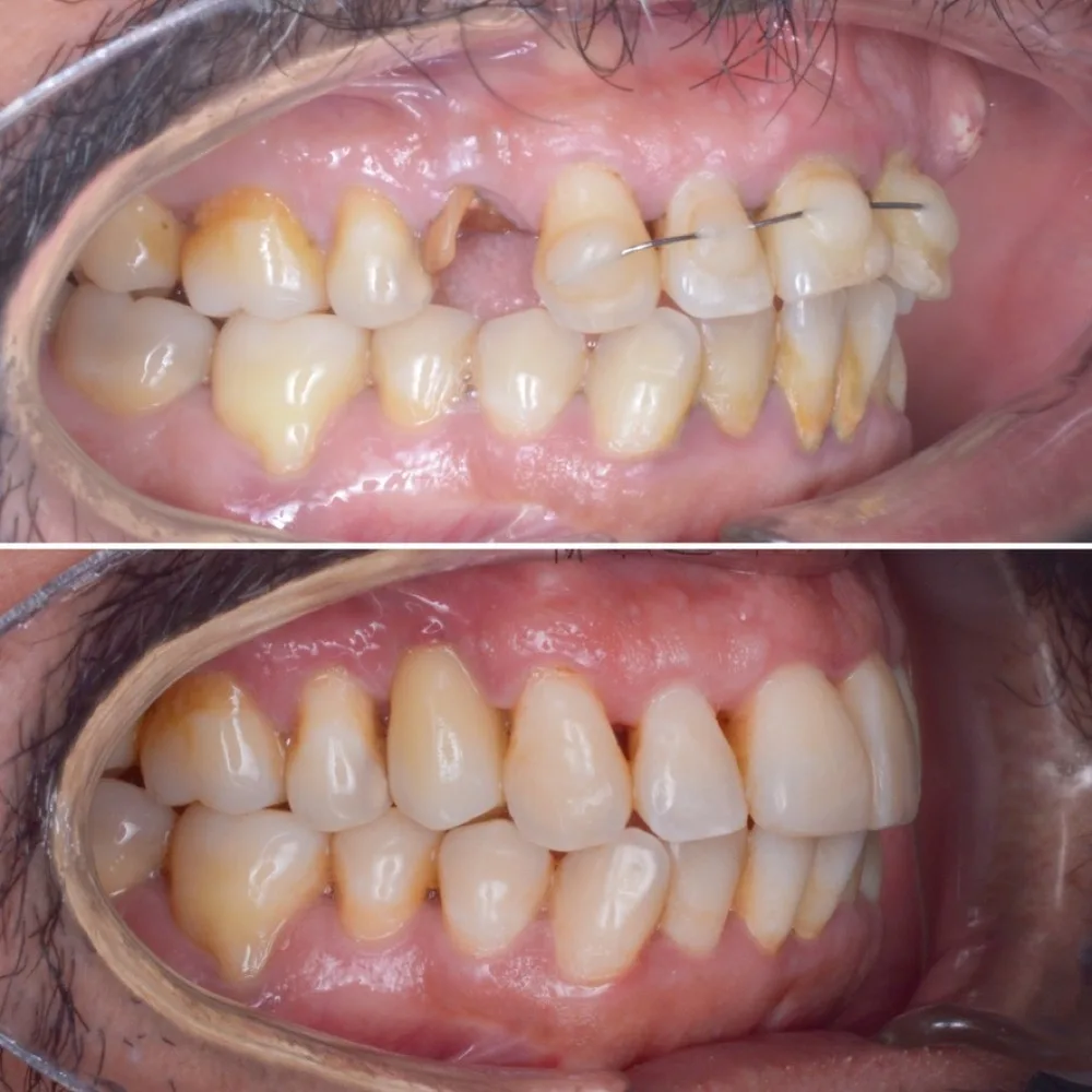 Implantes múltiples con rehabilitación — Lateral izquierdo