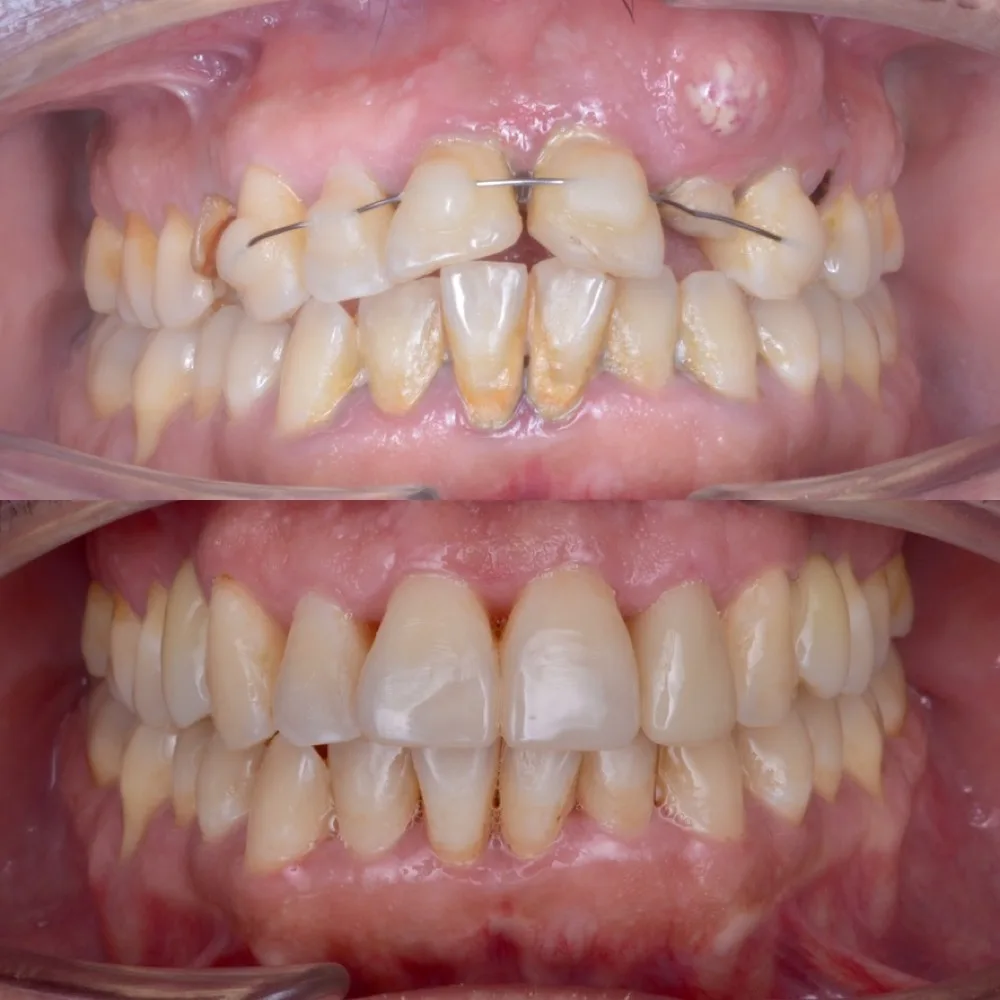 Implantes múltiples con rehabilitación — Frontal