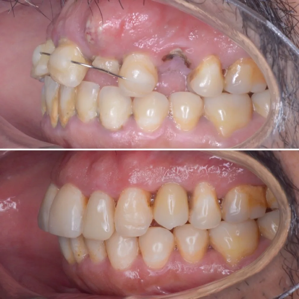 Implantes múltiples con rehabilitación — Lateral derecho