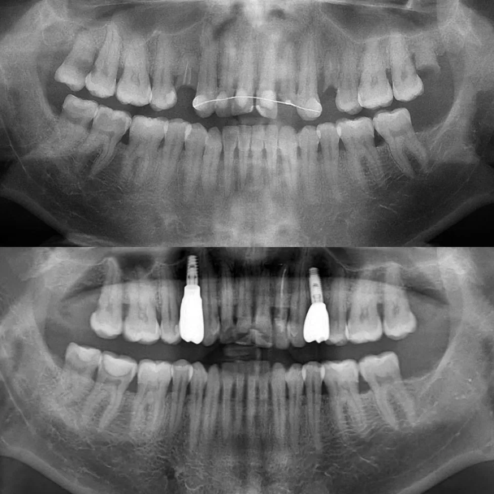Implantes múltiples con rehabilitación — Radiografía