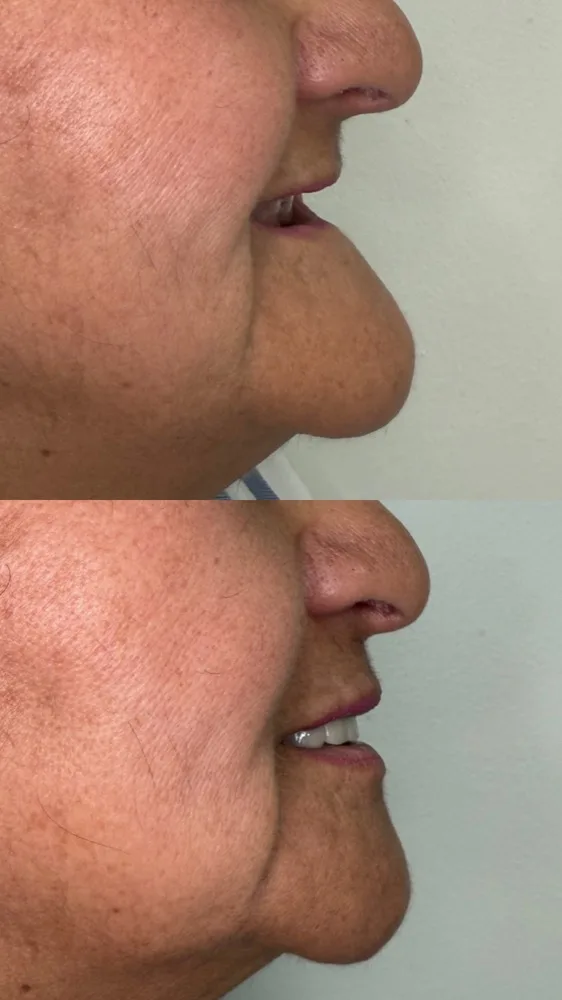 Rehabilitación estética con prótesis híbrida — Antes/después lateral