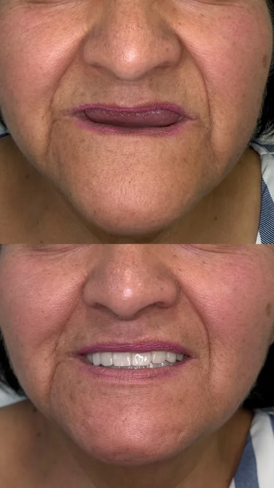 Rehabilitación estética con prótesis híbrida — Antes/después frontal