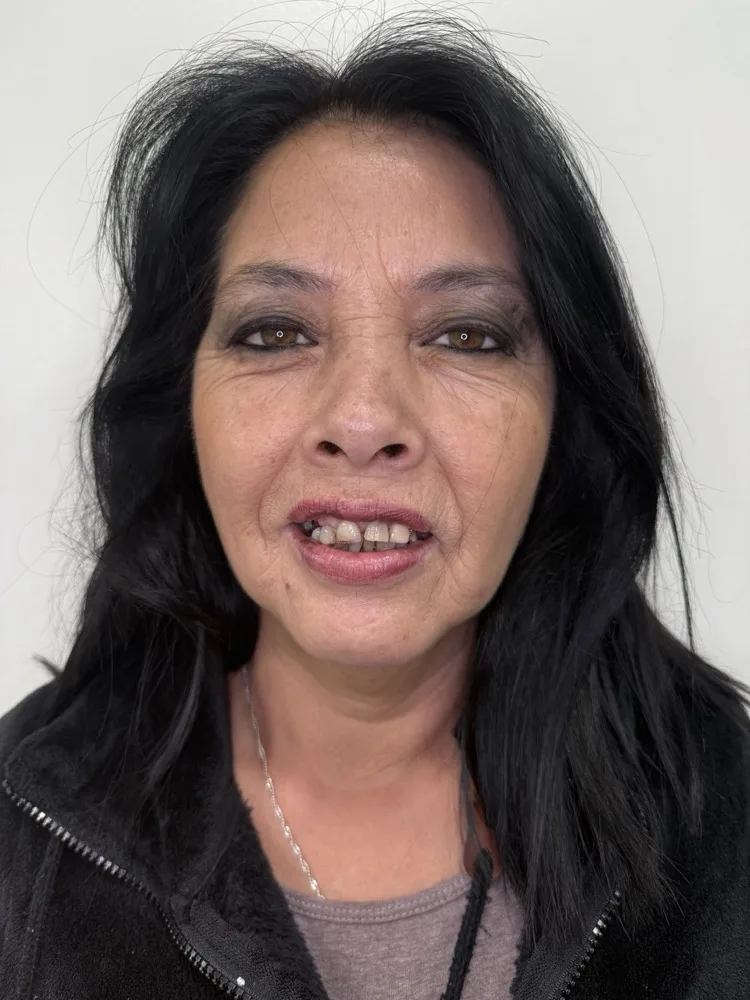 6 implantes, carga inmediata y rehabilitación total superior — Antes — rostro