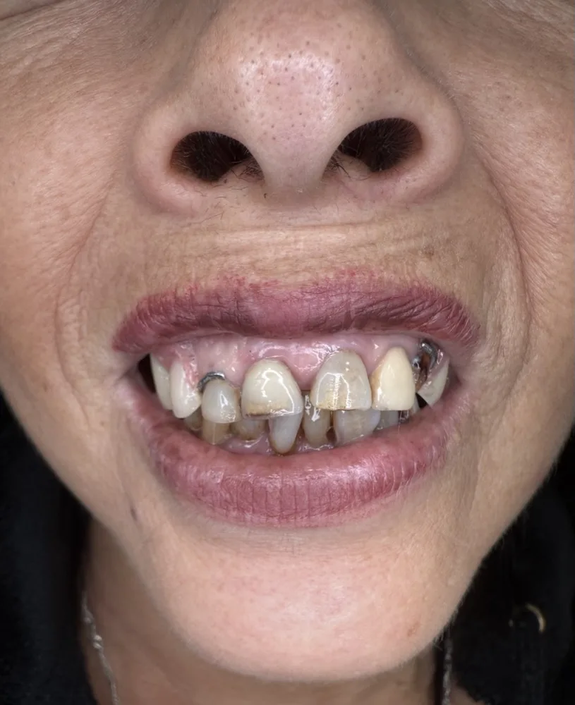 6 implantes, carga inmediata y rehabilitación total superior — Antes — close-up