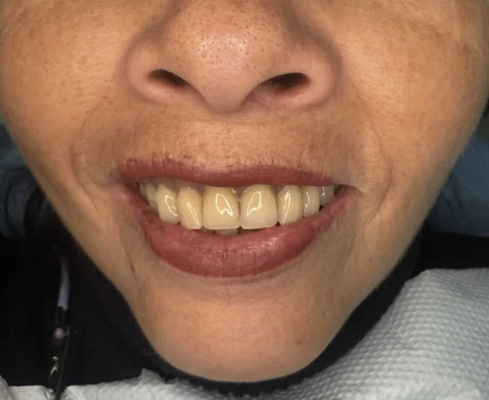 6 implantes, carga inmediata y rehabilitación total superior — Después — close-up