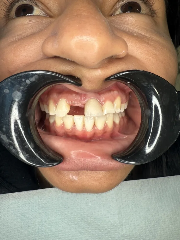 Implante unitario en sector anterior — Antes — intraoral
