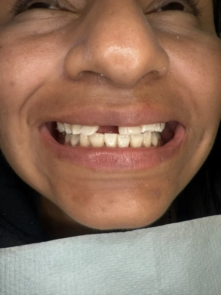 Implante unitario en sector anterior — Antes — sonrisa