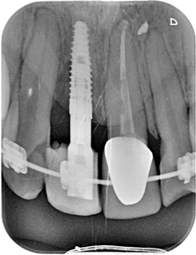Implante unitario en sector anterior — Radiografía del implante