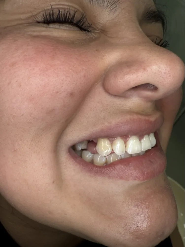 Extracción, implante inmediato y carga el mismo día — Antes — sonrisa