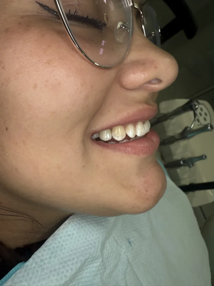 Implante inmediato con carga el mismo día — resultado