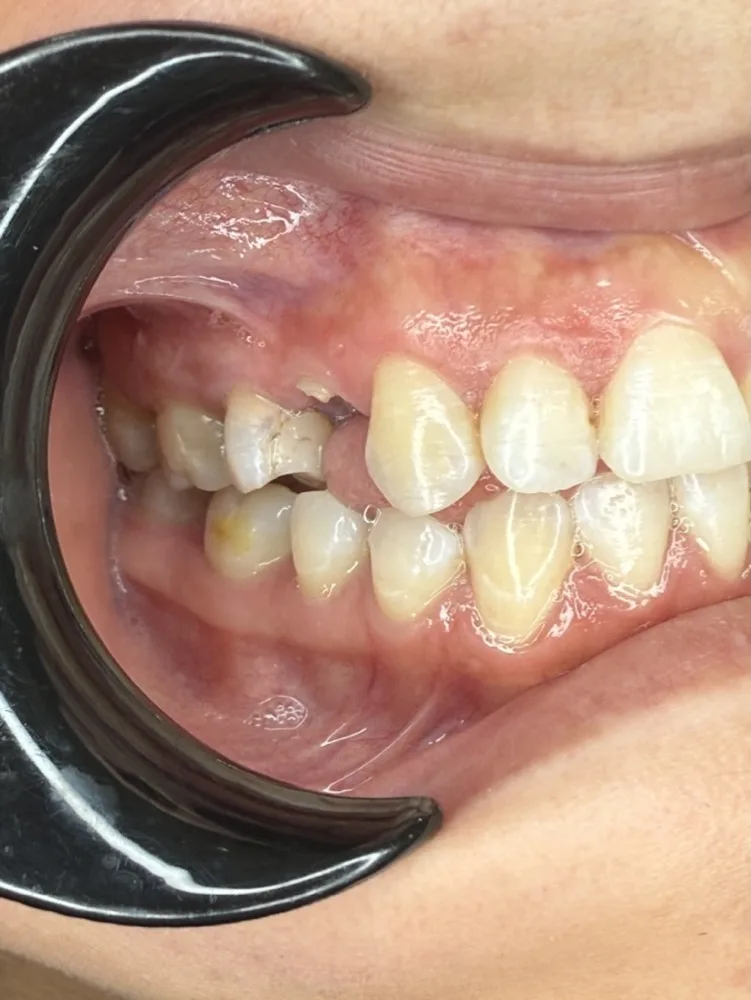 Extracción, implante inmediato y carga el mismo día — Antes — intraoral