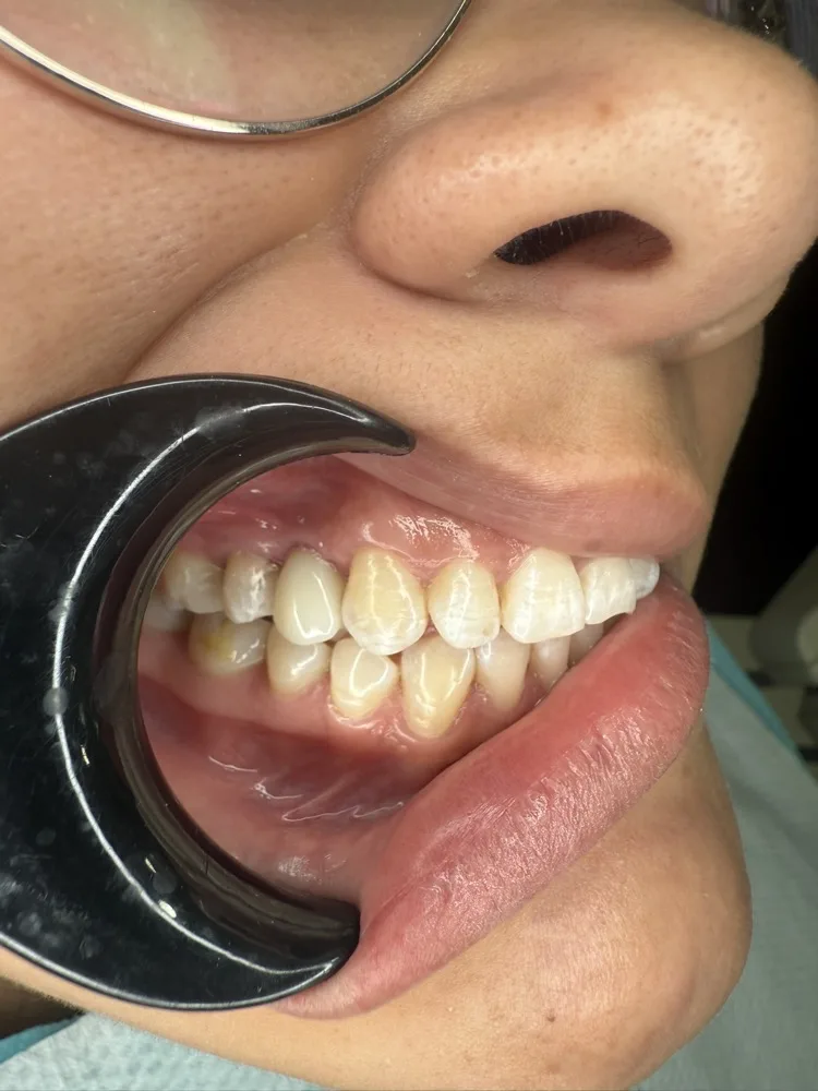 Extracción, implante inmediato y carga el mismo día — Después — intraoral