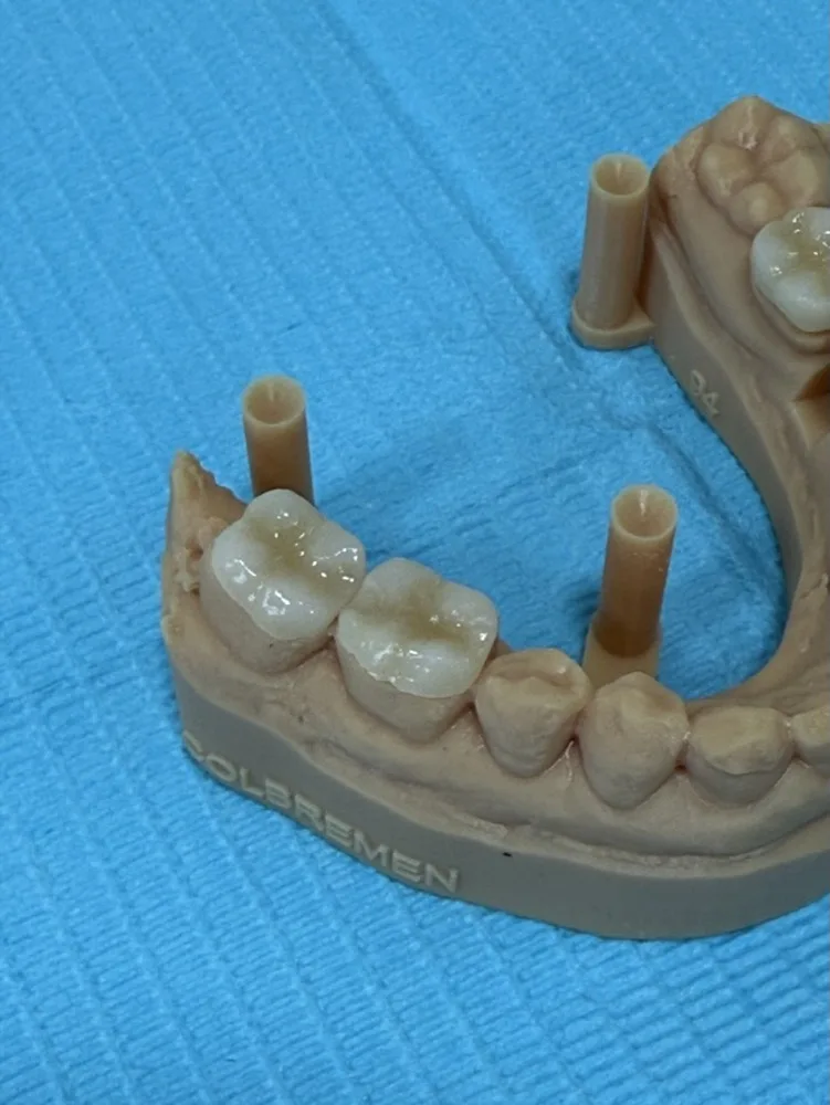 Ortodoncia, implantes y rehabilitación integral — Modelo con coronas